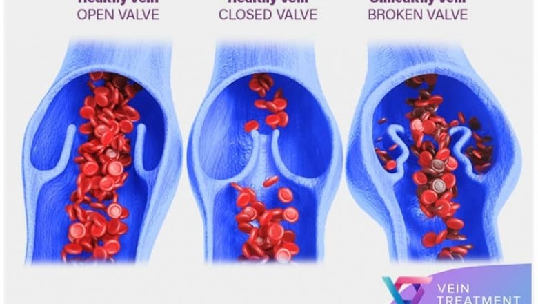 How to Find A Qualified Vein Doctor?