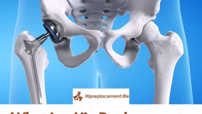 What is a Hip Replacement – Types & Procedure