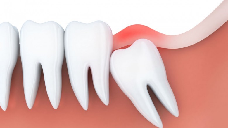 A complete guide of dental abscess
