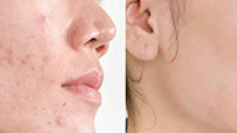 Is MedSpa A Good Option For Polishing The Skin?