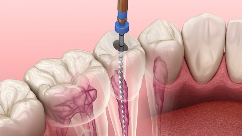 Walk in Dentist Near me in Houston