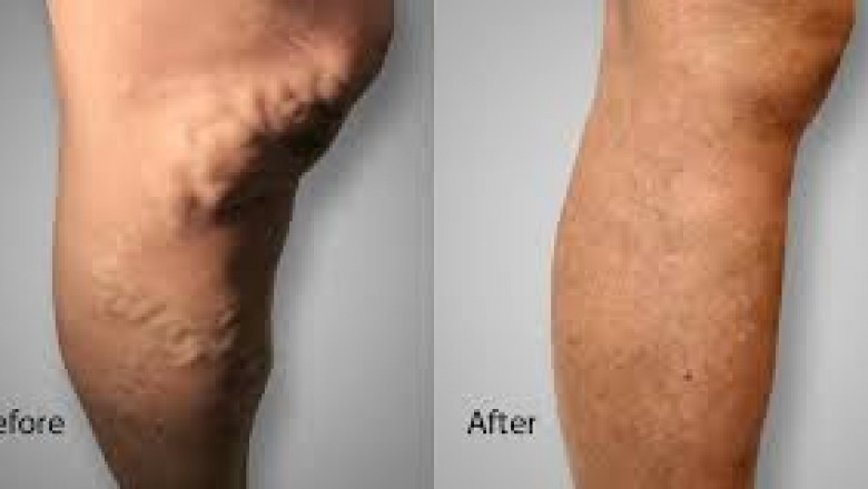Find Vein Treatment Near Me