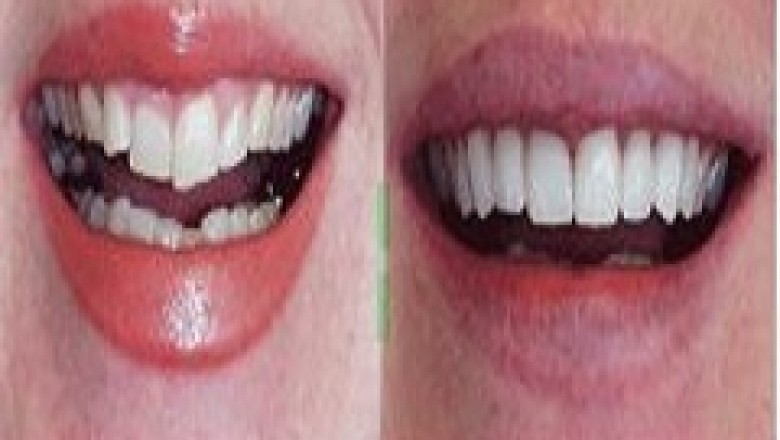 General Dentistry Services | East Beach Smiles