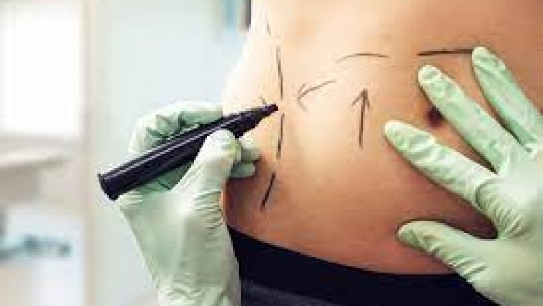 Liposuction: Everything You Need To Know