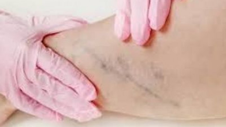 Midtown Vein Treatment Near Me