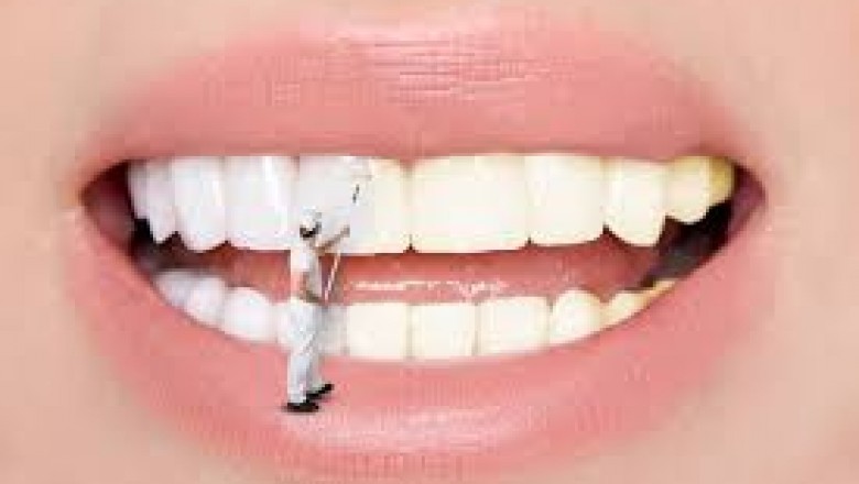 What are Porcelain Dental Veneers?