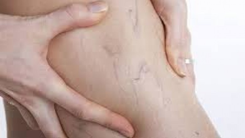 What are Some Less Invasive Treatments for Varicose and Spider Veins?