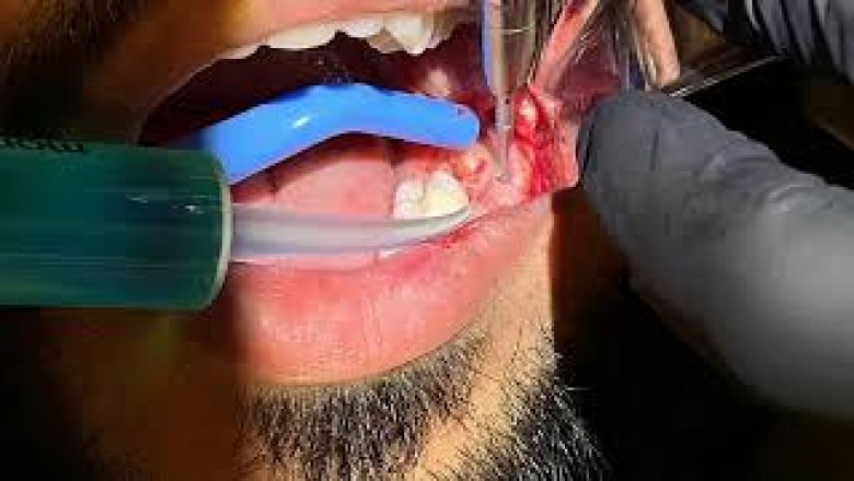 Wisdom Teeth Removal Surgery