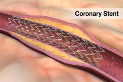 Gel Stent Market Size, Share, Outlook, and Opportunity Analysis, 2019– 2027