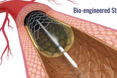 Bioengineered stents are a huge step forward in the medical field.