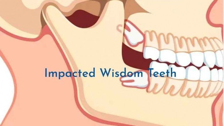 Wisdom Tooth Pain- My Gentle Dentist Arana Hills