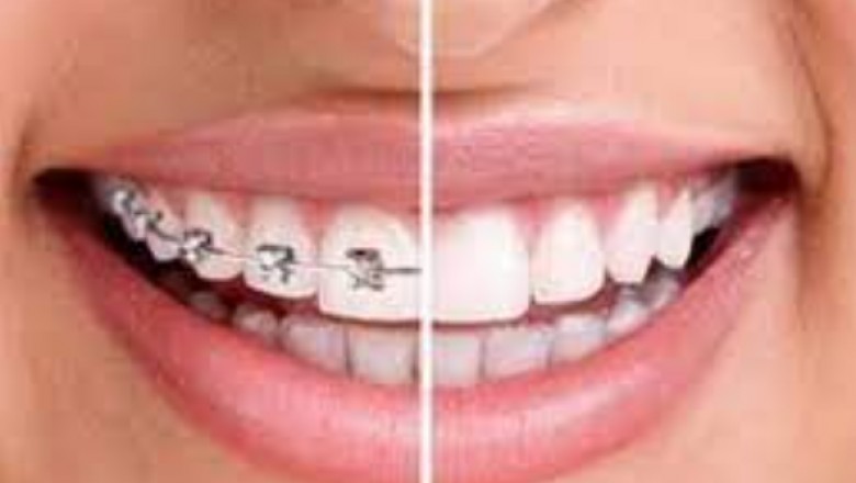 (LLLT)Low-level laser therapy in acclerating orthodontic tooth