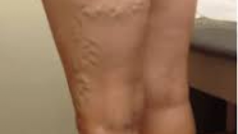 Spider Veins:Treatments To Eliminate Them Effectively.