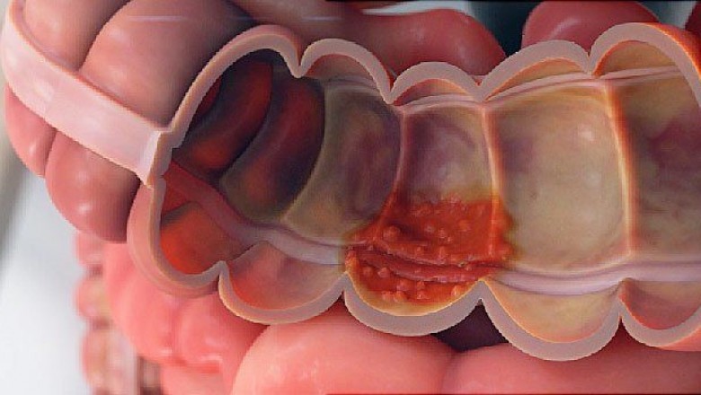 Ulcerative Colitis, an Inflammatory Bowel Disease, is More Prevalent in People with a Family History of Diabetes and Obesity