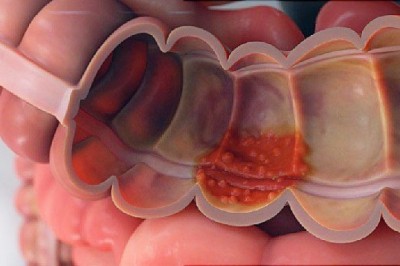 Ulcerative Colitis, an Inflammatory Bowel Disease, is More Prevalent in People with a Family History of Diabetes and Obesity
