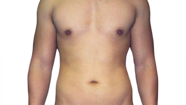 Everything Required To Understand About Vaser Liposuction