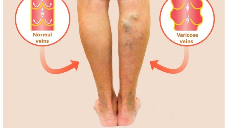 Five Exercises To Prevent Varicose Veins:
