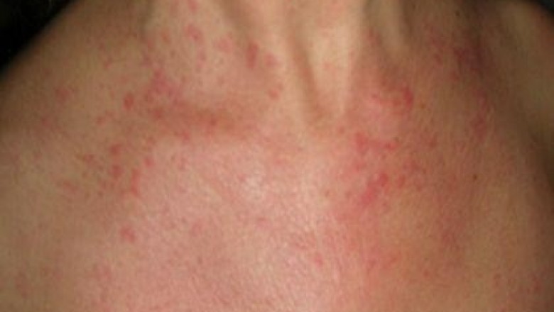 Still’s Disease Treatment Market Forecast Made Available By Top Research Firm 2027
