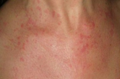 Still’s Disease Treatment Market Forecast Made Available By Top Research Firm 2027