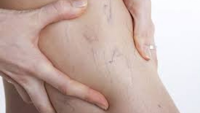 Varicose Vein Treatment - No Cuts & No Stitches