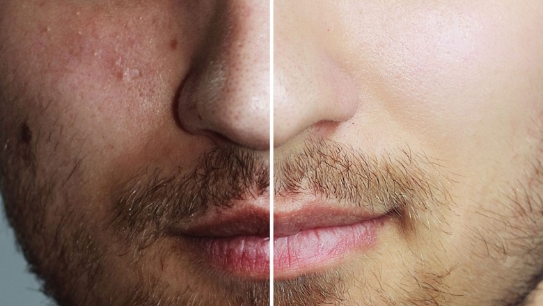 How Does Chemical Peel Procedure Enhance Your Skin?