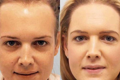 MTF and FTM Transgender Hair Transplant for Hair Loss