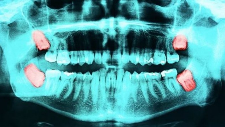 Cost of Crown Lengthening