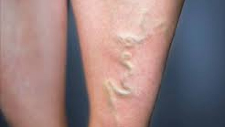 Is Polidocanol Safe For Varicose Vein Treatment?