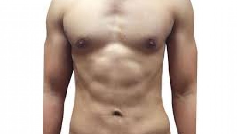 Liposculpture VS. Liposuction: Which One Is The Finest For The Body?