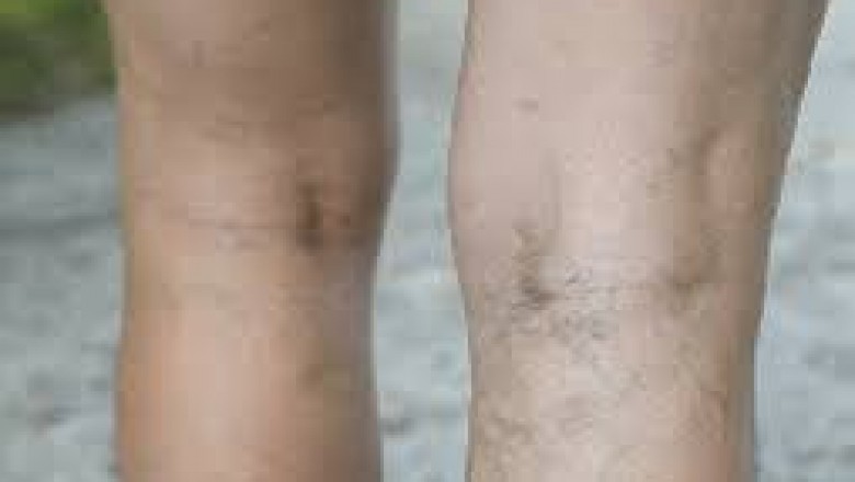 What Are The Typical Treatments For Varicose Veins?
