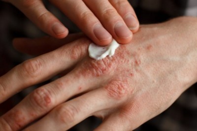 pruritus one of those skin conditions which can be helped by using LDN