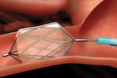 Transcatheter Embolization and Occlusion Devices are suitable for most patients suffering from various conditions like varicose veins, spider veins, varicose or leg ulcers, etc