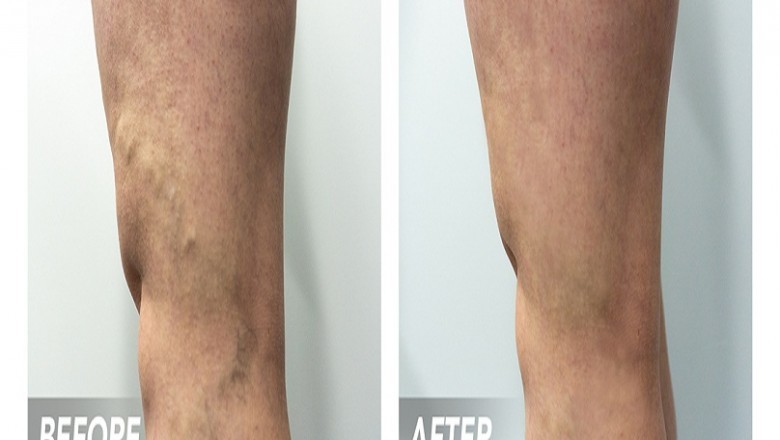 How many spider vein treatments are necessary?
