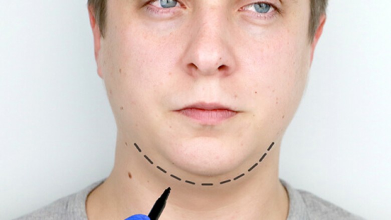 Genioplasty Surgery in Delhi