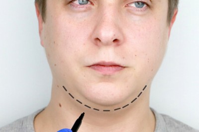 Genioplasty Surgery in Delhi