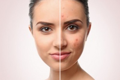 Acne Vulgaris Treatment - Why Herbal Medicines are Best Treatment For Acne Vulgaris