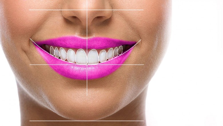 Hollywood Smile Design Hyderabad| Hollywood Smile Designing Cosmetic Dental Clinic Hyderabad
