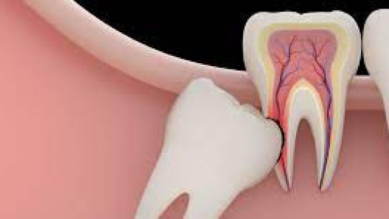 The positive side of wisdom teeth removal