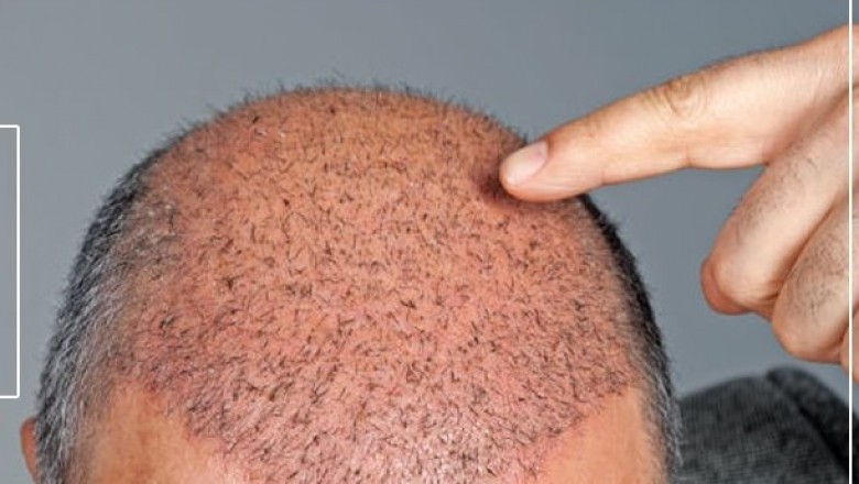 Following a hair transplant, you may undergo some hair loss.
