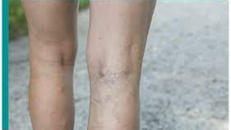 NYC Varicose Vein Treatment Center Near Me