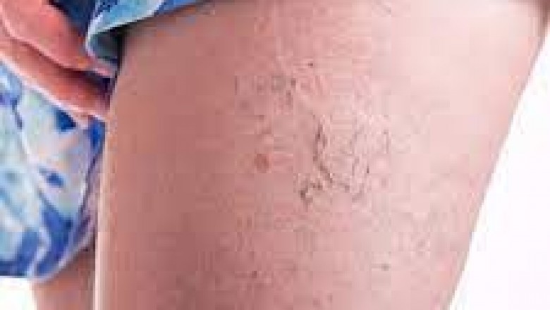 NYC Varicose Vein Treatment Center