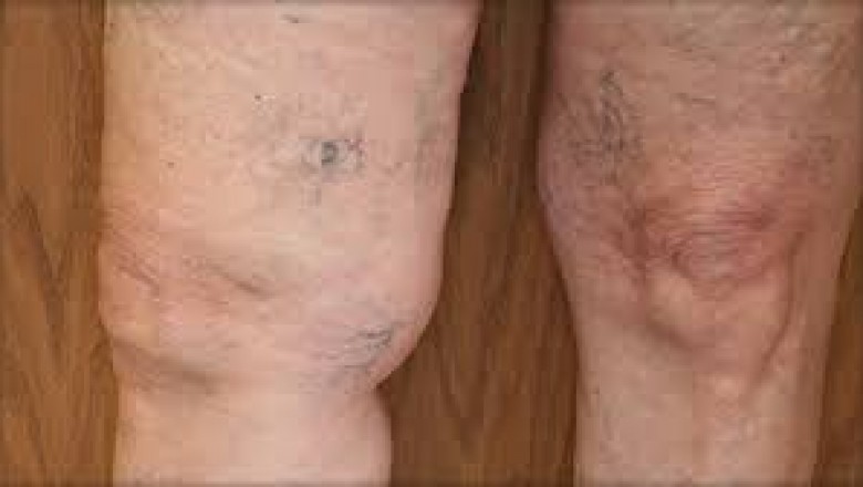 Top 10 Spider Vein Treatment Centres near me in San Jose
