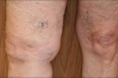 Top 10 Spider Vein Treatment Centres near me in San Jose