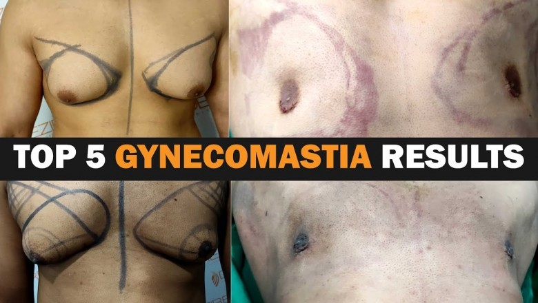 Best Five Gynecomastia ( Manboobs ) Results !! Before & After !! Dr. Prashant Yadav