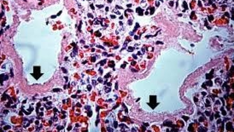 Neonatal Respiratory Distress Syndrome Treatment Market – Growth, Latest Trend & Forecast 2027