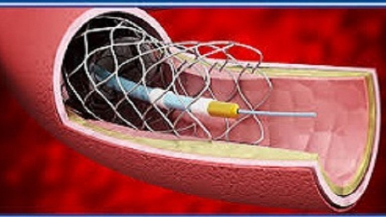 Peripheral Vascular Devices are Also Used in the Peripheral Endovascular and Coronary Procedure