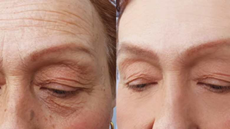 What are the Benefits, Side Effects, and Cost of Dermaplaning?