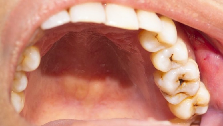 Dental Implant: What Should You Know?