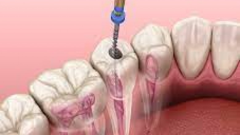 Root Canal Doctor Near Me