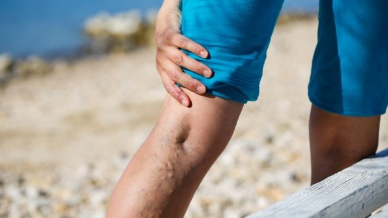 Vein Treatments: What Are The Different Ways?